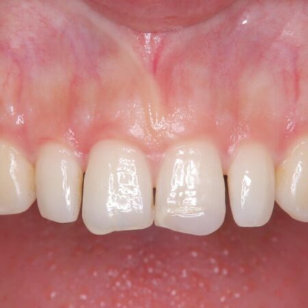 矯正治療後、セラミックで審美修復 治療前