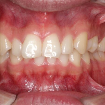 ガタつきや深い嚙み合わせ、気になるところを一気に解決 治療前