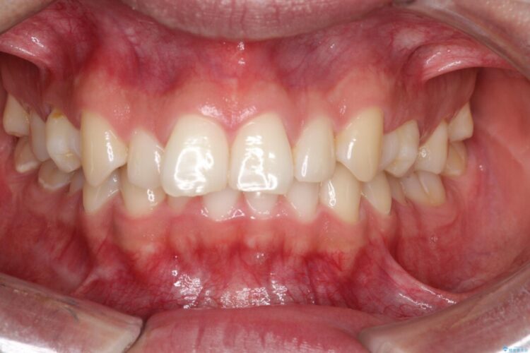 ガタつきや深い嚙み合わせ、気になるところを一気に解決 治療前画像