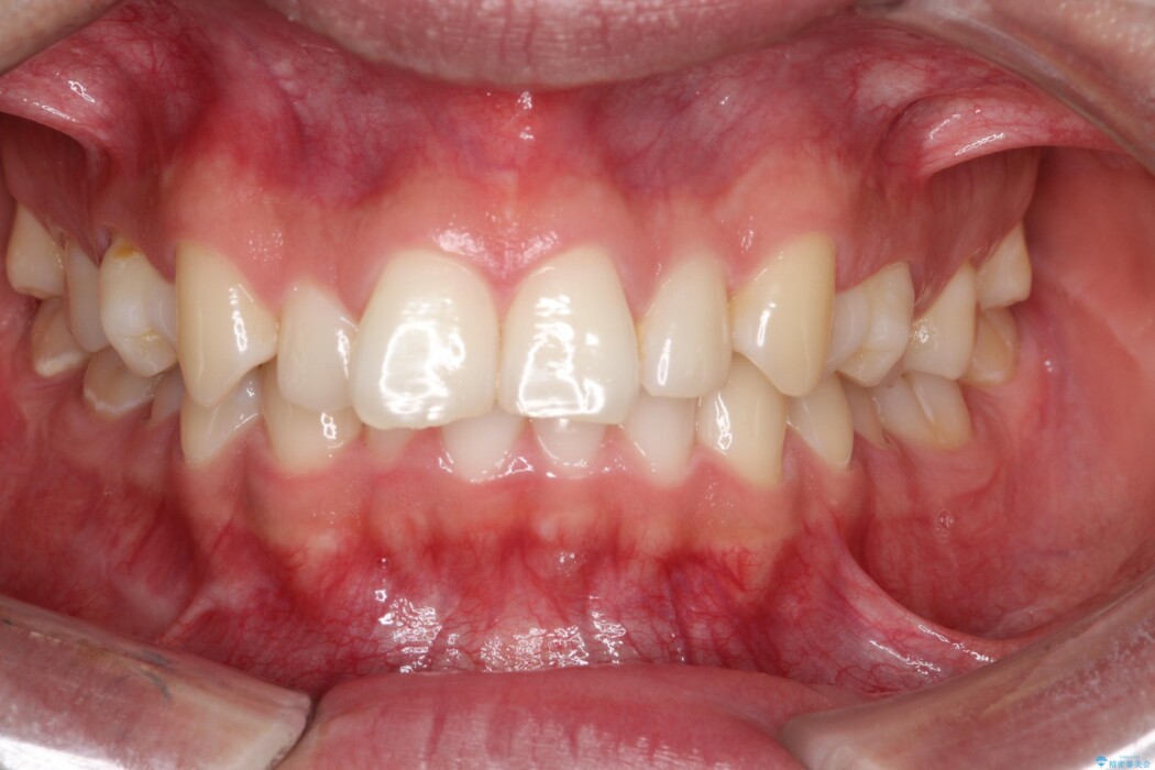 ガタつきや深い嚙み合わせ、気になるところを一気に解決 治療前