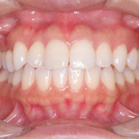 非抜歯、短期間で。審美性の高い装置で目立ちにくい矯正治療 治療前