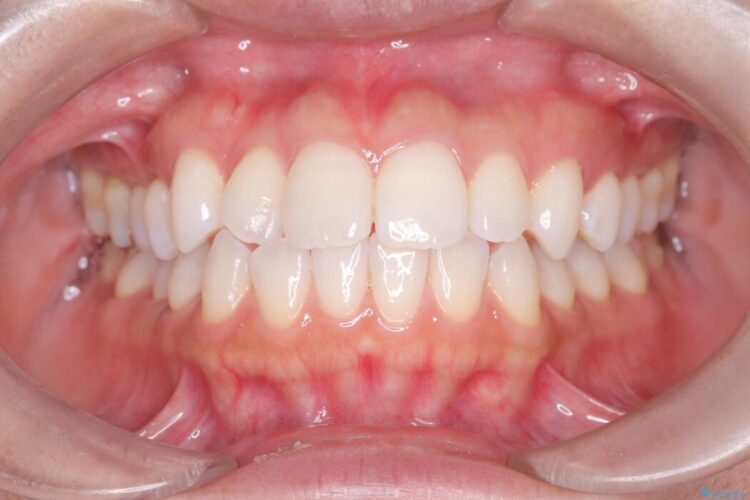 非抜歯、短期間で。審美性の高い装置で目立ちにくい矯正治療 治療前画像