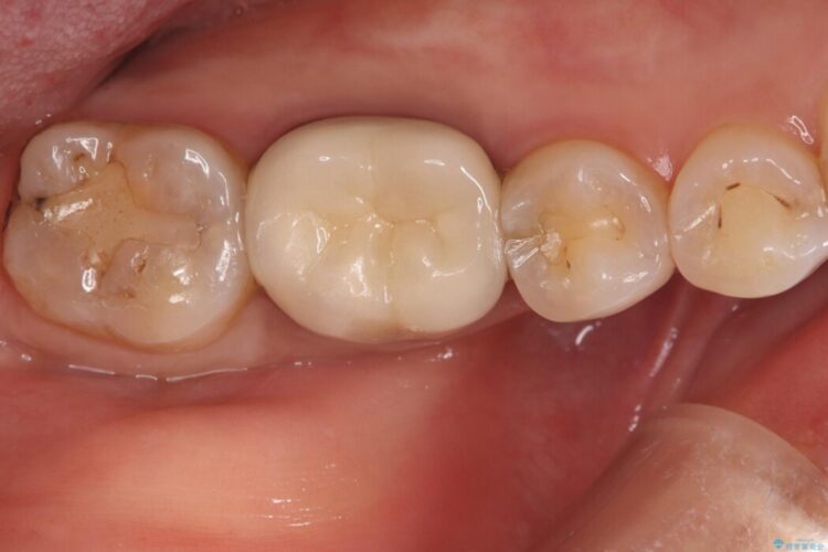 奥歯の奥側にできてしまった虫歯 治療前画像