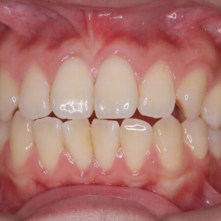 前歯の突出感とガタつきをワイヤー矯正で美しく 治療前