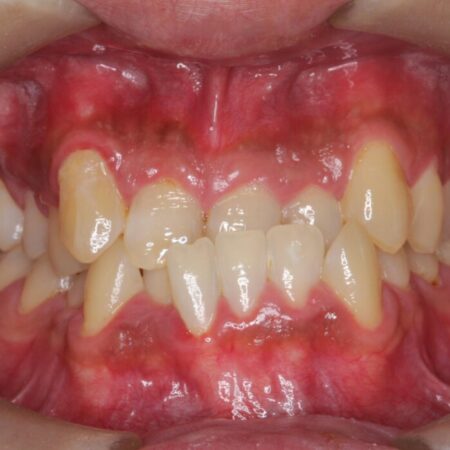 ワイヤー矯正で嚙み合わせの改善 治療前