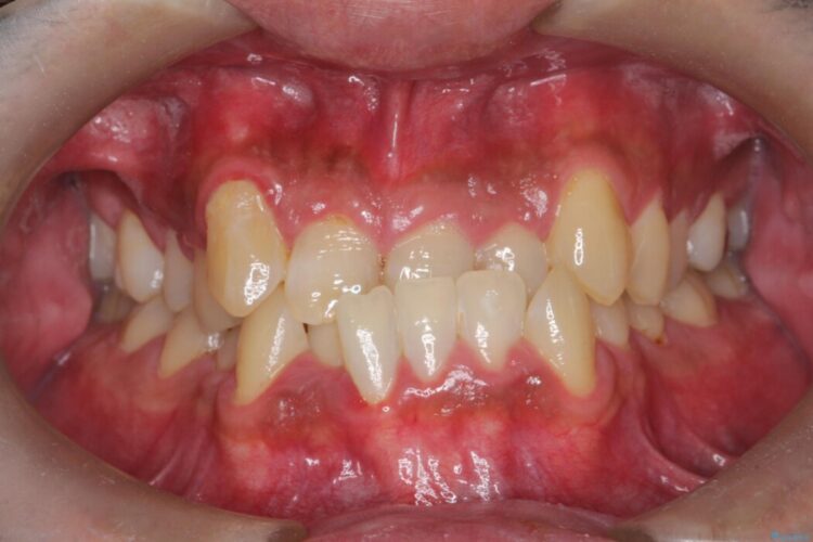 ワイヤー矯正で嚙み合わせの改善 治療前画像