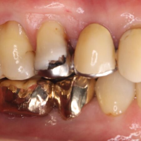 ブリッジの歯の一部が欠けてしまった 治療前