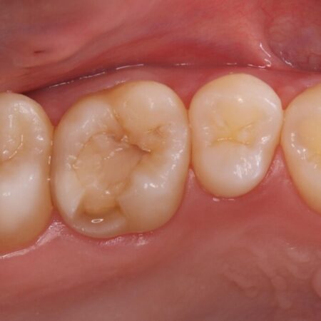 欠けた歯の修復 治療前