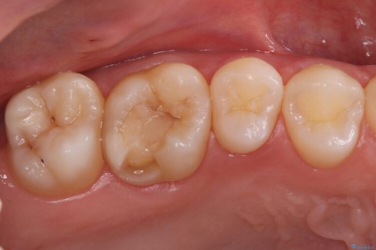 欠けた歯の修復 治療前画像