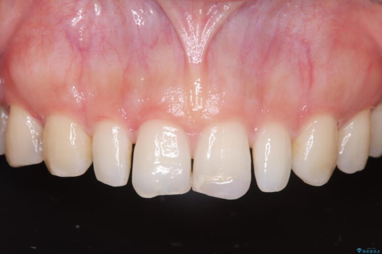 矯正治療後、セラミックで審美修復 治療前画像