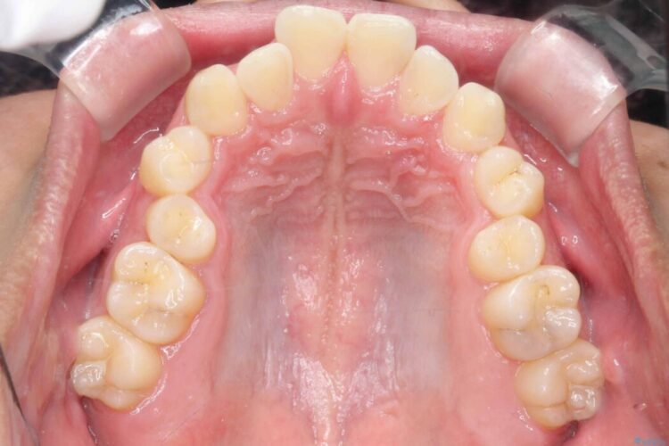 ガタつきや深い嚙み合わせ、気になるところを一気に解決 治療前画像