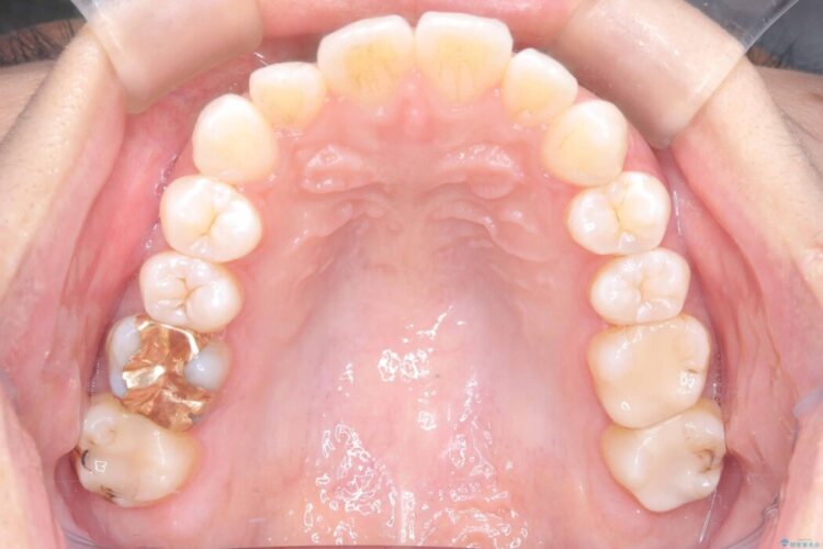 非抜歯、短期間で。審美性の高い装置で目立ちにくい矯正治療 治療前画像