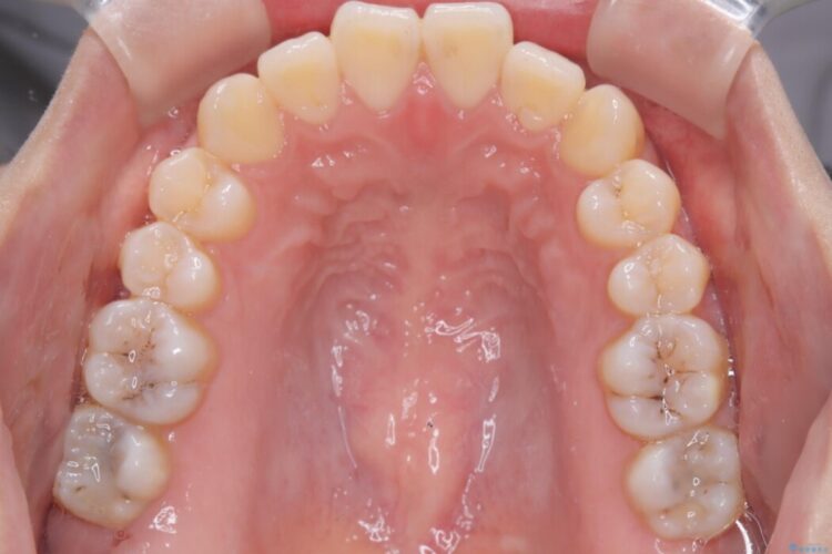 前歯の突出感とガタつきをワイヤー矯正で美しく 治療前画像