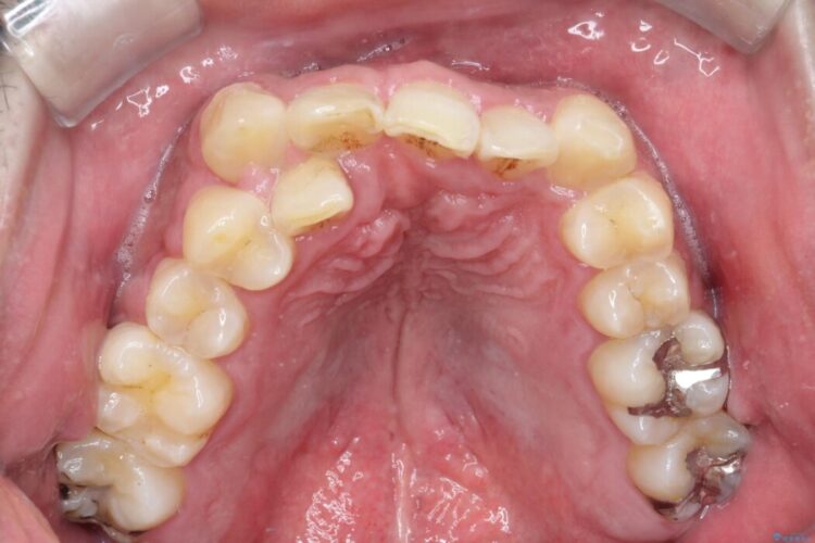 ワイヤー矯正で嚙み合わせの改善 治療前画像