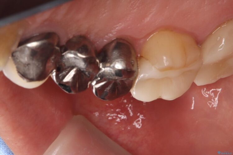 ブリッジの歯の一部が欠けてしまった 治療前画像