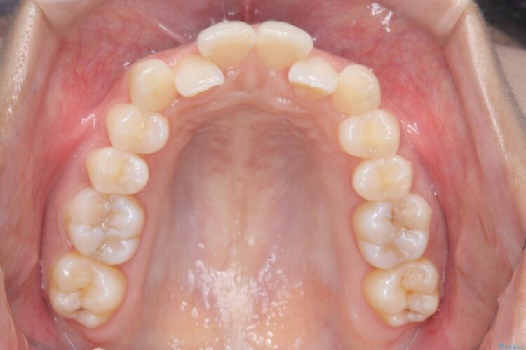 1年で変わる！非抜歯ワイヤー矯正でガタつきの改善 治療前画像