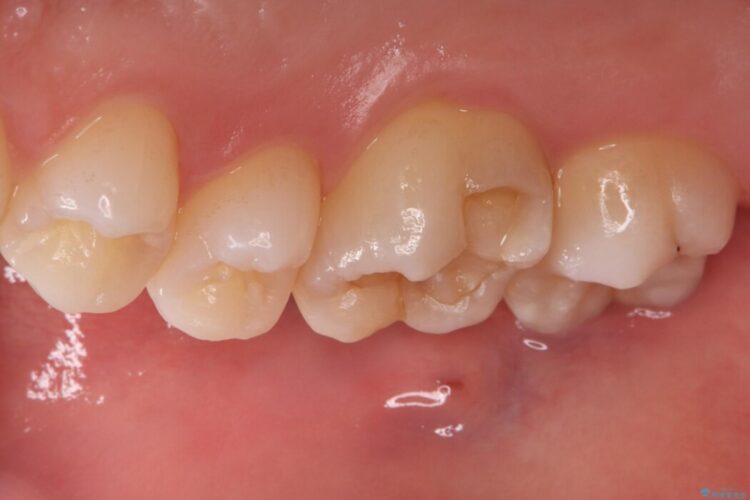 欠けた歯の修復 治療前画像