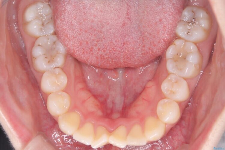 前歯の突出感とガタつきをワイヤー矯正で美しく 治療前画像