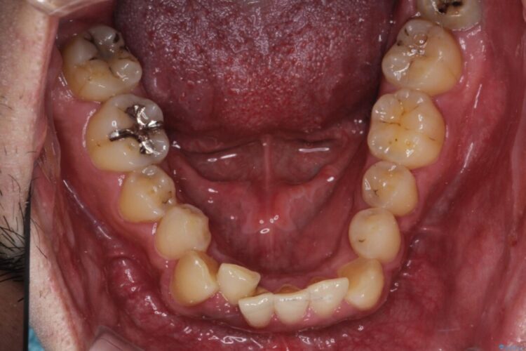 ワイヤー矯正で嚙み合わせの改善 治療前画像