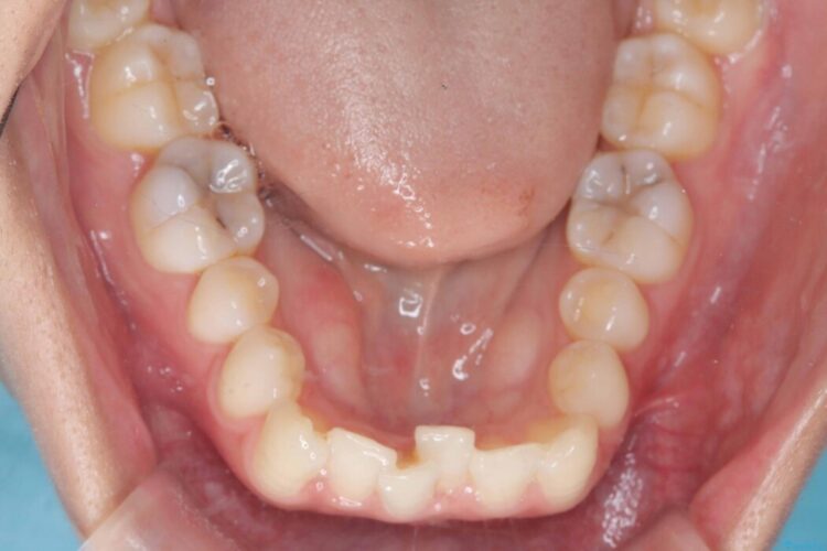 1年で変わる！非抜歯ワイヤー矯正でガタつきの改善 治療前画像