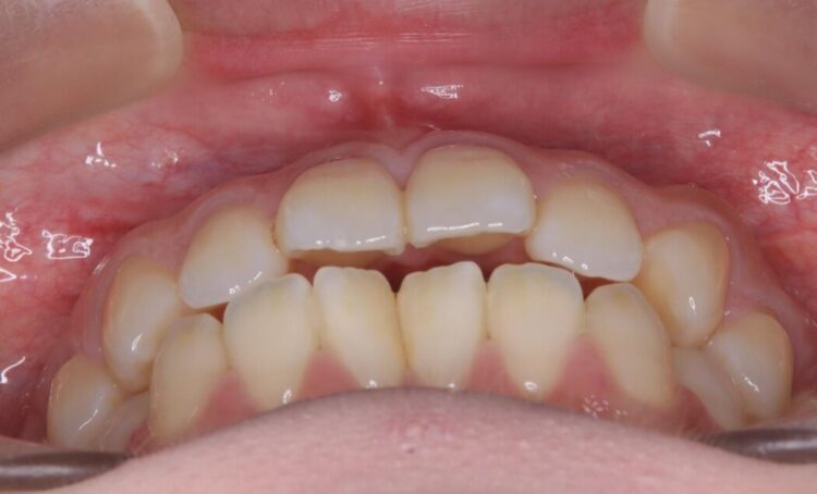 前歯の突出感とガタつきをワイヤー矯正で美しく 治療前画像