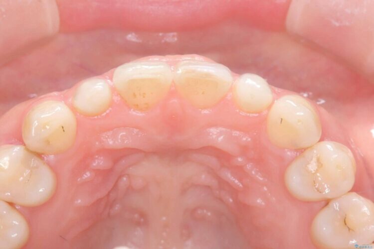 矯正治療後、セラミックで審美修復 治療前画像