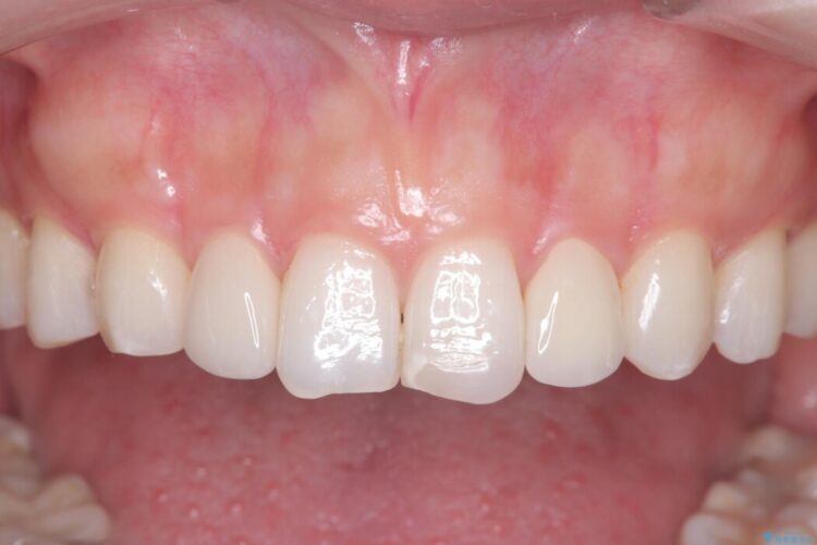 矯正治療後、セラミックで審美修復 治療後画像