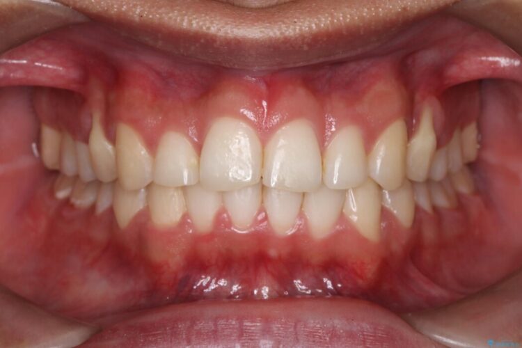 ガタつきや深い嚙み合わせ、気になるところを一気に解決 治療後画像