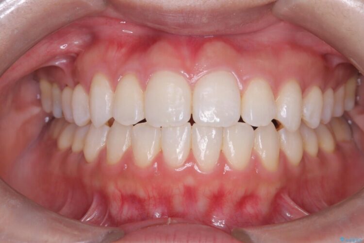 非抜歯、短期間で。審美性の高い装置で目立ちにくい矯正治療 治療後画像