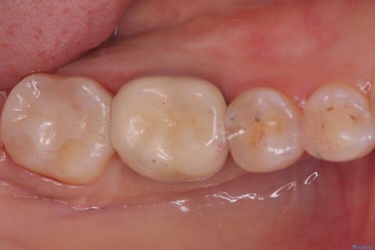 奥歯の奥側にできてしまった虫歯 治療後画像