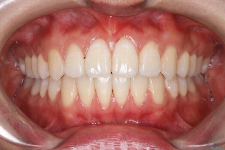 前歯の突出感とガタつきをワイヤー矯正で美しく 治療後画像