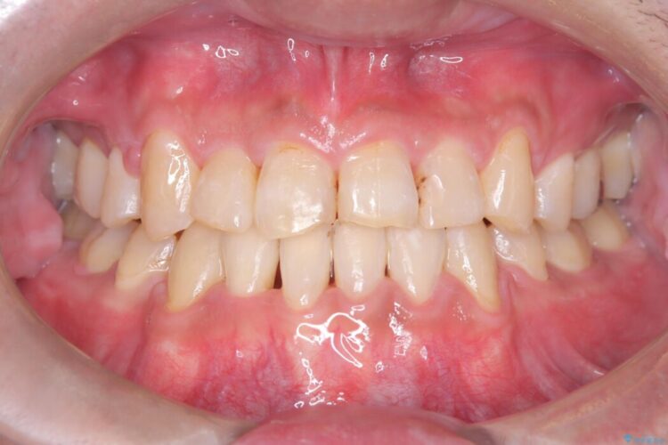 ワイヤー矯正で嚙み合わせの改善 治療後画像