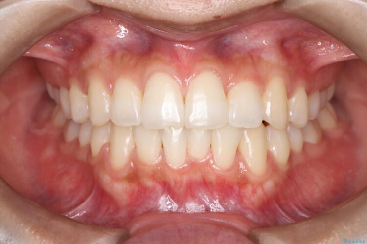 1年で変わる！非抜歯ワイヤー矯正でガタつきの改善 治療後画像