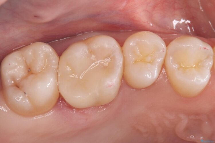 欠けた歯の修復 治療後画像