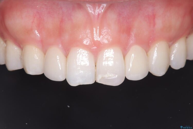 矯正治療後、セラミックで審美修復 治療後画像