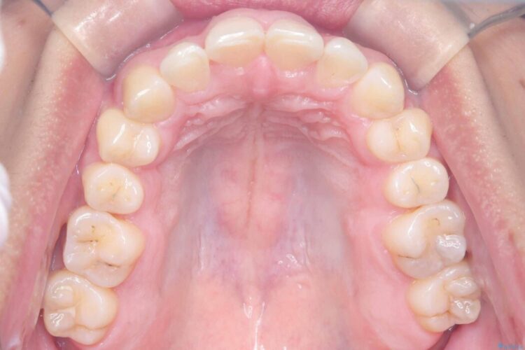 ガタつきや深い嚙み合わせ、気になるところを一気に解決 治療後画像