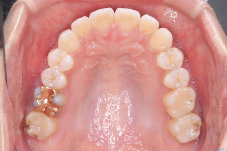非抜歯、短期間で。審美性の高い装置で目立ちにくい矯正治療 治療後画像