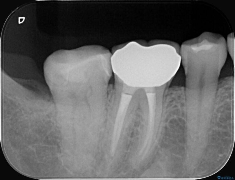 奥歯の奥側にできてしまった虫歯 治療後画像