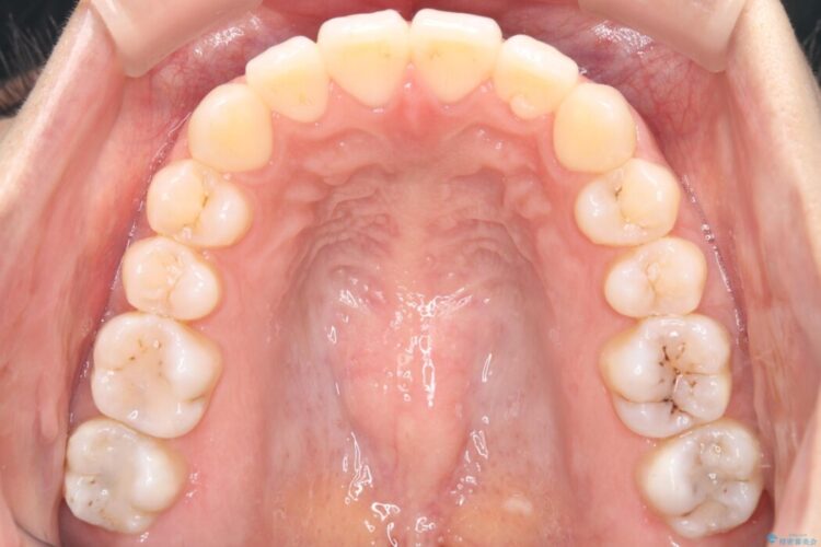 前歯の突出感とガタつきをワイヤー矯正で美しく 治療後画像