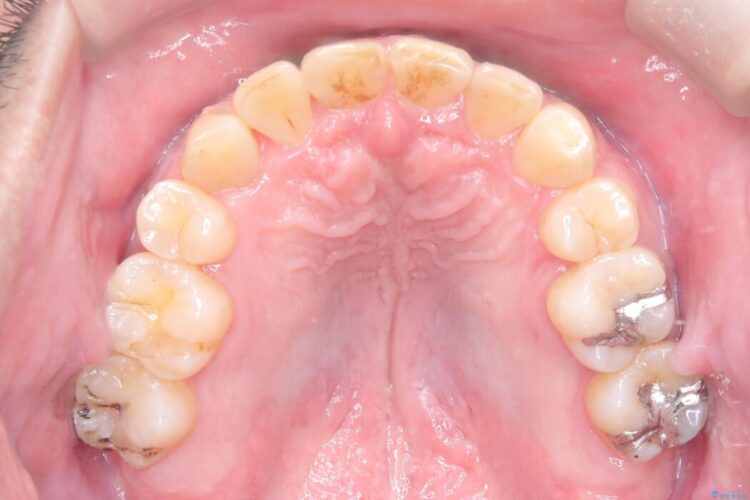 ワイヤー矯正で嚙み合わせの改善 治療後画像