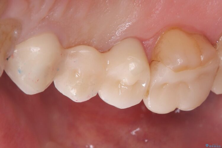 ブリッジの歯の一部が欠けてしまった 治療後画像