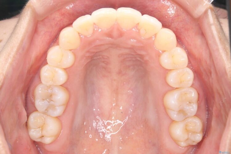 1年で変わる！非抜歯ワイヤー矯正でガタつきの改善 治療後画像