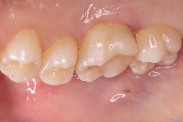 欠けた歯の修復 治療後画像