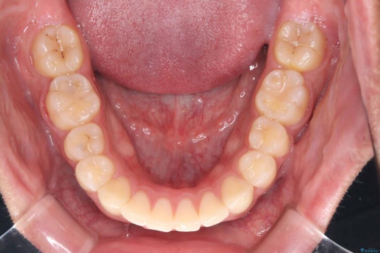 ガタつきや深い嚙み合わせ、気になるところを一気に解決 治療後画像