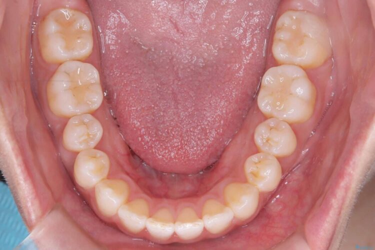 非抜歯、短期間で。審美性の高い装置で目立ちにくい矯正治療 治療後画像