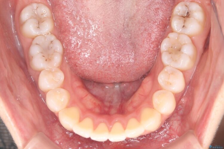 前歯の突出感とガタつきをワイヤー矯正で美しく 治療後画像