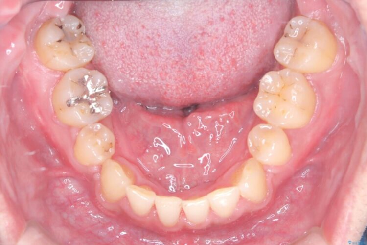 ワイヤー矯正で嚙み合わせの改善 治療後画像