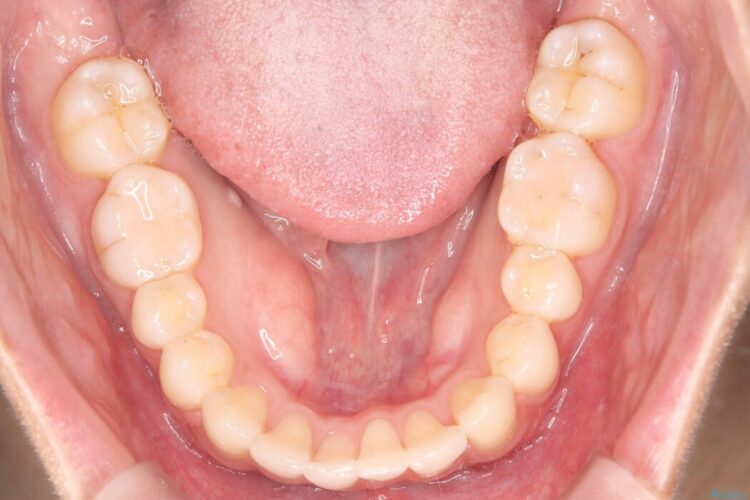 1年で変わる！非抜歯ワイヤー矯正でガタつきの改善 治療後画像