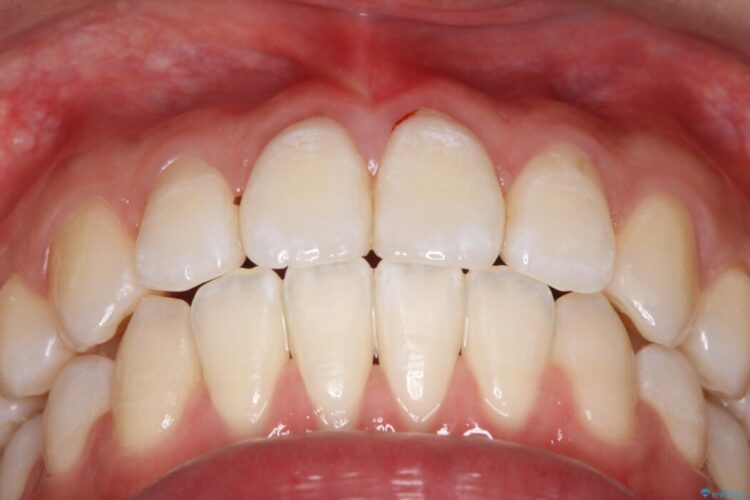 前歯の突出感とガタつきをワイヤー矯正で美しく 治療後画像