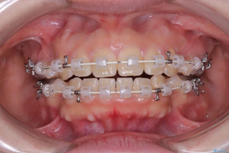 「口元の突出感」を解消。前歯を下げてスッキリした口元へ 治療途中画像